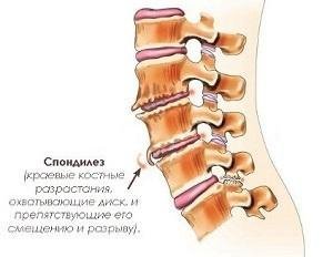 Spondylosis deformans